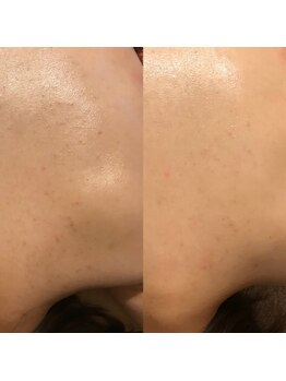 メジェール/BODYピーリング♪