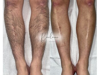 カイラニ サロン(Kai lanl salon)/男性　ひざ下
