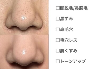 ピュアノア 垂水店/ 産毛脱毛 顔脱毛　神戸垂水明石