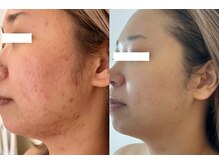 れふぇるん 足利店/30代 ニキビケア 施術10回