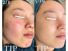 エヌ(N)/ハーブピーリングでの変化