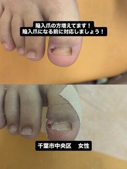 巻き爪じゅん 千葉駅前店/長年悩んだ陥入爪の痛みの改善