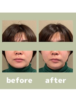 プラス(APLUS)/美容鍼灸　施術前後