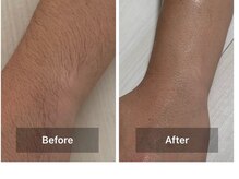 エムズ ラウンジ 上大岡店(M's Lounge)/脱毛後ビフォーアフター