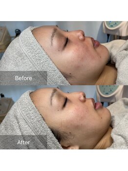 マリモ鍼灸接骨院/一回でも効果あるララピール♪