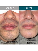 モモナ(Momona)/佐世保/脱毛/髭脱毛/全身脱毛