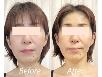 ドクターボディ 新宿店(Dr.Body)/【顎の歪み/左右差/面長 50代】