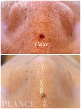 プランス 恵比寿店(PLANCE)/毛穴洗浄