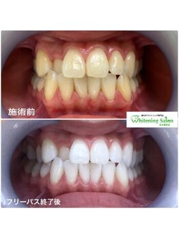ホワイトニングサロン 名古屋駅店/【ホワイトニング施術例】