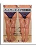 【ハイパーナイフで脂肪分解】理想の体型に★6部位90分¥33000→¥16500