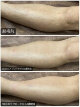 リレア(RELAIR)/【あし脱毛/ビフォーアフター】