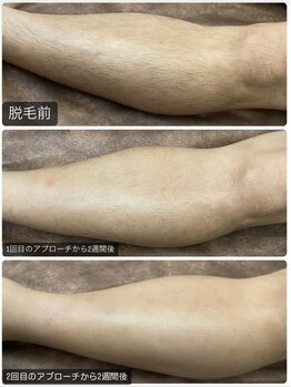 リレア(RELAIR)/【あし脱毛/ビフォーアフター】