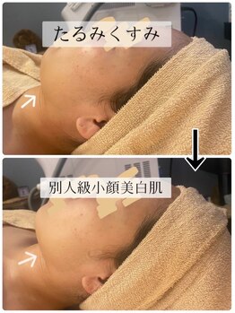 肌音色/■カスマラパック施術例