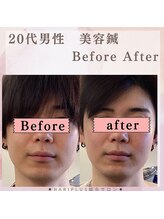 ハリプラス(HariPlus)/美容鍼ビフォーアフター