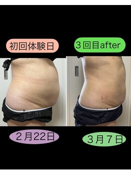 ビーオリビン(B-olivine)/お腹集中コース　C様