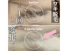 サロン(SALON)/メンズ脱毛：ワキ