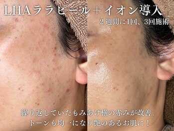 エムラボ 池袋店(M LABO)/LHAララピール＋イオン導入