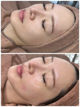 マリモ鍼灸接骨院/【肌革命】ララピール♪