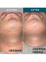 モモナ(Momona)/佐世保/脱毛/髭脱毛/全身脱毛