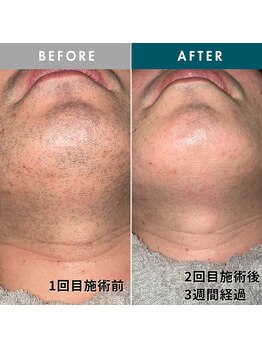 モモナ(Momona)/佐世保/脱毛/髭脱毛/全身脱毛