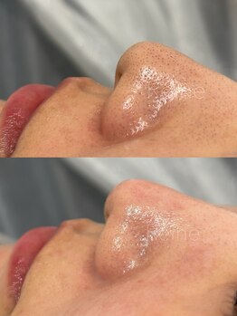 レーヌ(Reine)/毛穴＋ピコジェット＋臍帯原液