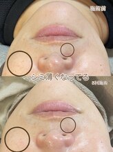 ニコリ(Nicori)/シェービングエステ