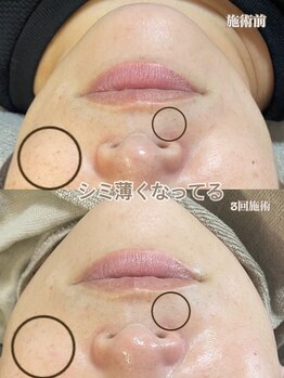 ニコリ(Nicori)/シェービングエステ