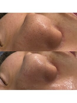 ニューフェイス(NEW FACE)/毛穴洗浄