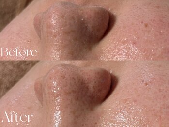 ウィハナ(wehana)/【毛穴洗浄×ポレーション導入】