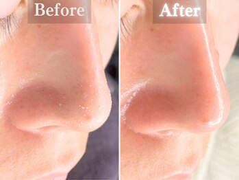 ボーンオム(Born Homme)/毛穴洗浄+美容液導入:30代女性