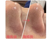 ケーエピ 長居(K-epi)/最新機器：毛穴洗浄