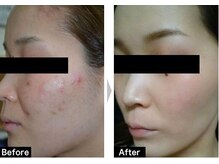 モテ肌 小顔コルギサロン カムトゥルー(come true)/ハーブピーリングで透明感キメUP