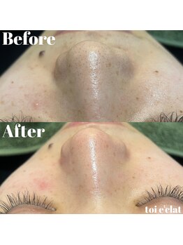 トワエクレ(toi e'clat)/ハイドラ☆毛穴洗浄