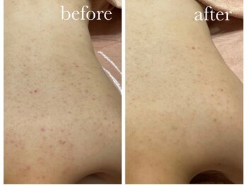 シャルナ(charna)/背中ハーブ