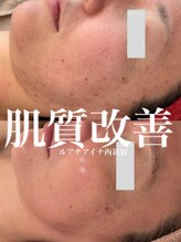 ルアナアイナ(Luana Aina)/ハーブピーリングでニキビケア