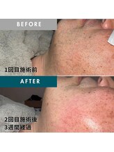 モモナ(Momona)/佐世保/脱毛/髭脱毛/全身脱毛