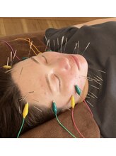 センコウ(SENKOU)/美容鍼