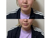 ルピナス 立川店/小顔矯正