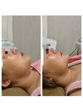 GRACETHOUSAND(グレイスサウザンド)/【肌質改善】ハーブピーリング