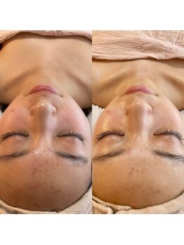 ララルアナ(Lara luana)/潤いフェイシャルケア