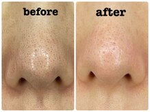 KMB 恵比寿店/毛穴洗浄+光+炭酸ガスパック