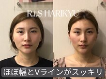 リス(R.i.S)/小顔矯正Before&After