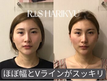 リス(R.i.S)/小顔矯正Before&After