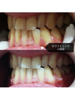 RiとBiのたまご/歯のホワイトニング1回