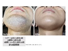 中国整体リラクゼーション 桜月/ヒゲ脱毛(12回照射)