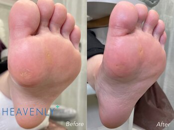 ヘブンリープラス＋ Luz湘南辻堂店/タコ 魚の目 フット ネイルケア