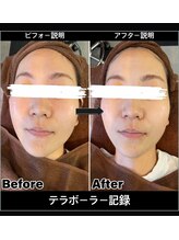 ルル 宜野湾店(RuRu)/テラボーラー毛穴引き締めパック