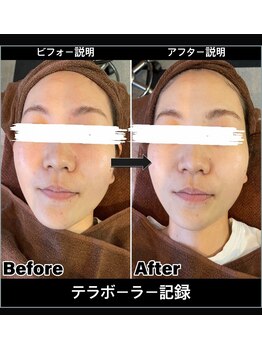 ルル 宜野湾店(RuRu)/テラボーラー毛穴引き締めパック