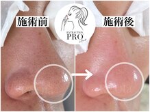 ニュートラル(neutral)の雰囲気（毛穴美人コースのお肌のビフォーアフター/毛穴の黒ずみ除去）