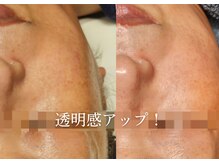 アマランサス(Amaranthus)/くすみを改善し、透明肌へ